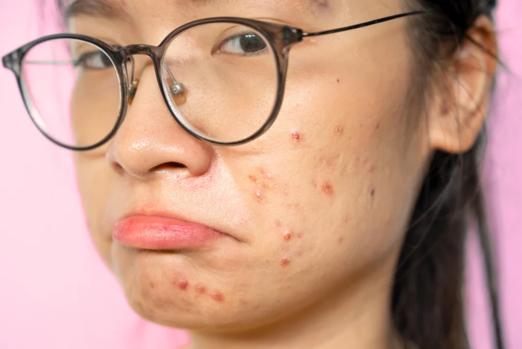 pimple patches do not work on cystic acne, a girl showing her face with breakouts and blemishes