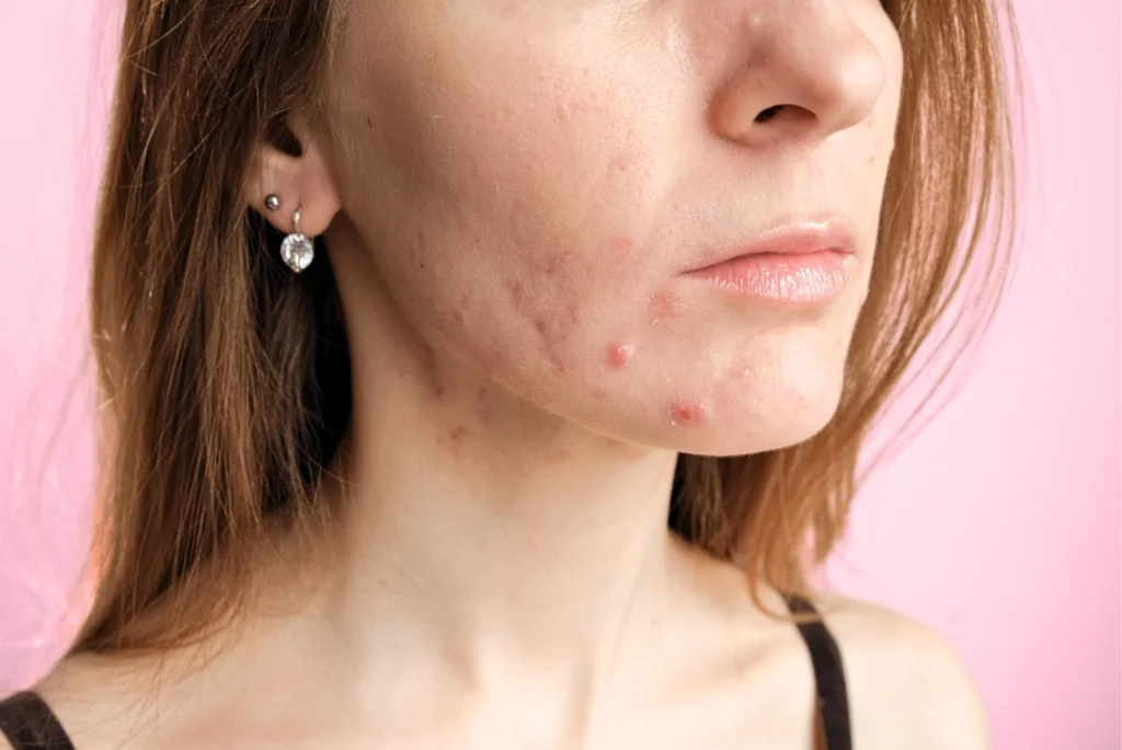 A closeup of a woman's chin with hormonal acne, demonstrating when not to use a pimple patch because of the type of acne or blemish it is